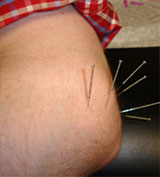 allergy acupuncture houston