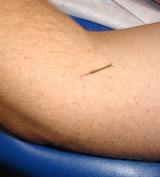 arthritis acupuncture houston