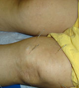  bone spurs acupuncture