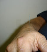 diabetes acupuncture houston