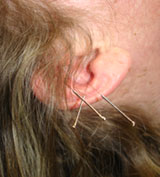 Ear acupuncture