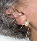 ear acupuncture