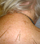 frozen shoulder acupuncture houston