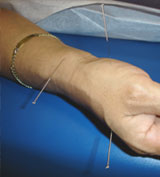 high blood pressure acupuncture houston