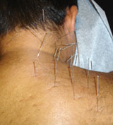 quit smoking acupuncture houston