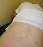 weight loss acupuncture houston